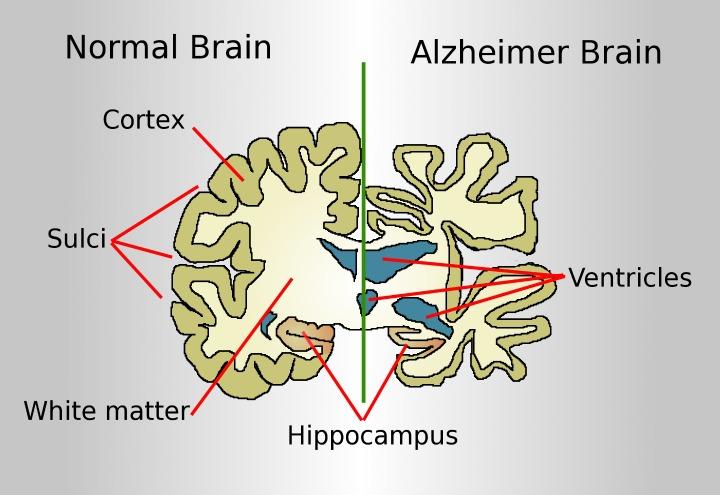 Alzheimer_wikimedia_commons_2017