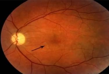 eye-worm-630-r375