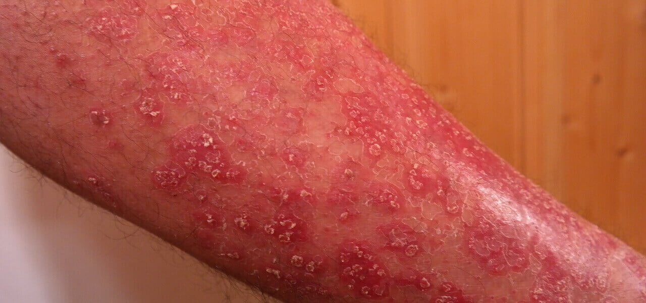 psoriasi 2019 pixabay