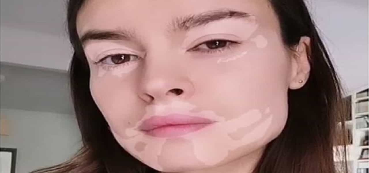 kasia smytniak filtro vitiligine min