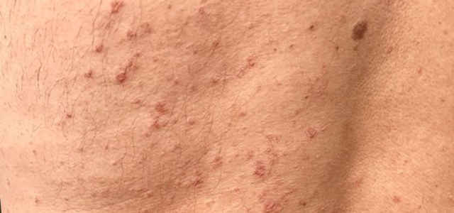 Eruzioni cutanee: ecco quando sono sintomi del Covid-19