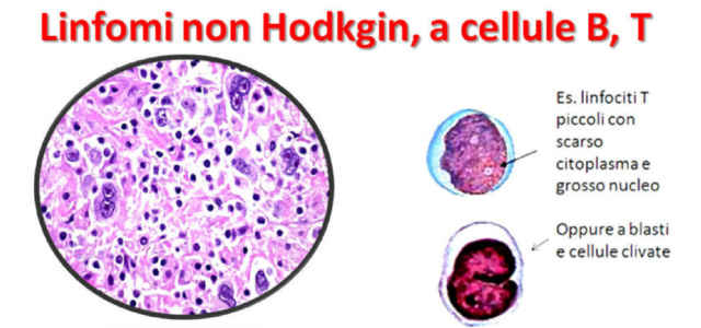Linfoma Non-Hodgkin, Malattia Di Roberto Mancini/ Cos’è? Sintomi, Cura ...