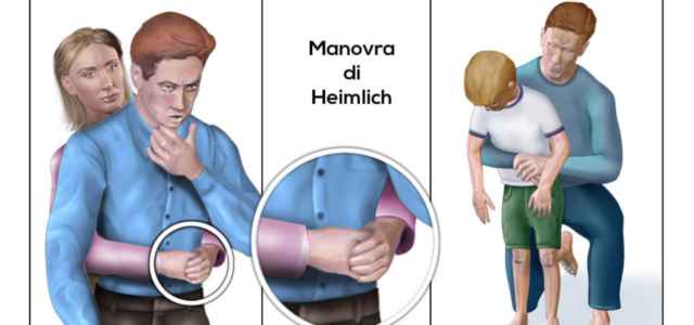 Manovra di Heimlich
